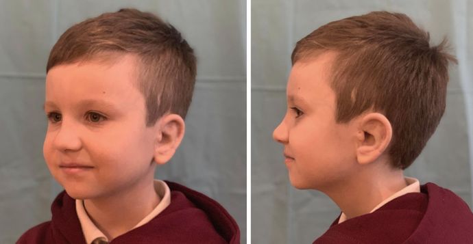 Boy seen 4 years & 4.5 years after left & right ear reconstruction surgeries.