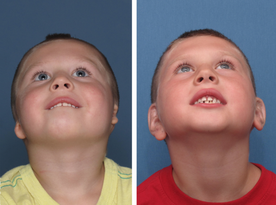 3.5 years following right & left ear reconstructions.