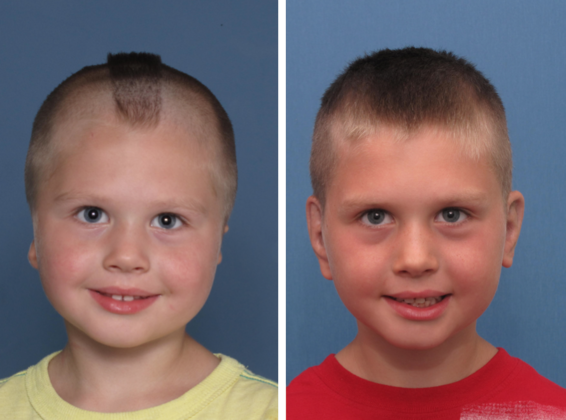 3.5 year old boy from Wisconsin with bilateral microtia.