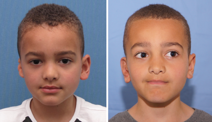 Single Ear: Case 3 - A 6 year old boy from Holland seen before & 2 years after surgery.
