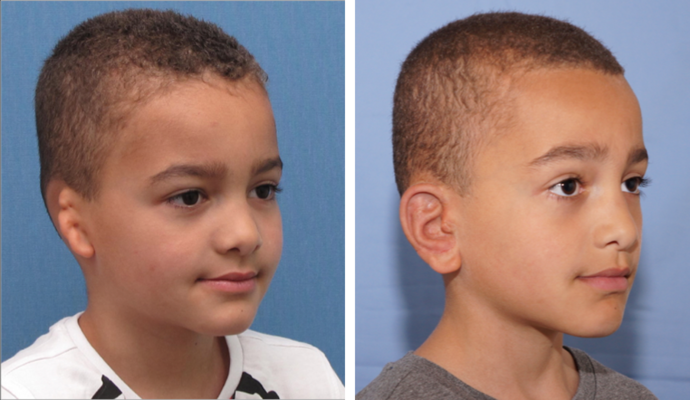 Single Ear: Case 3 - A 6 year old boy from Holland seen before & 2 years after surgery.