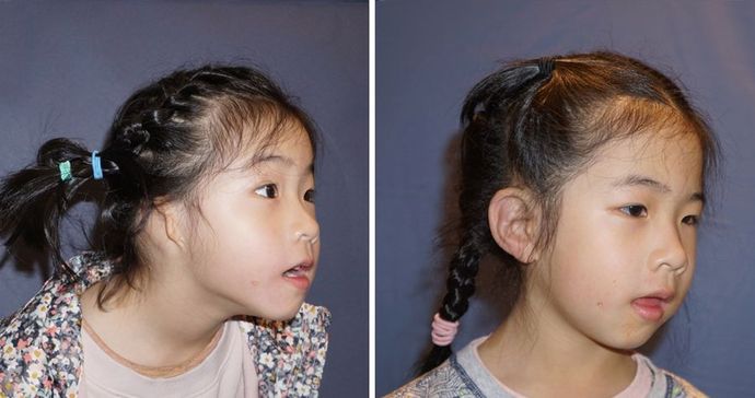 Single Ear: Case 4 - A 4 year old girl from China before & 1 year after a single Medpor surgery.
