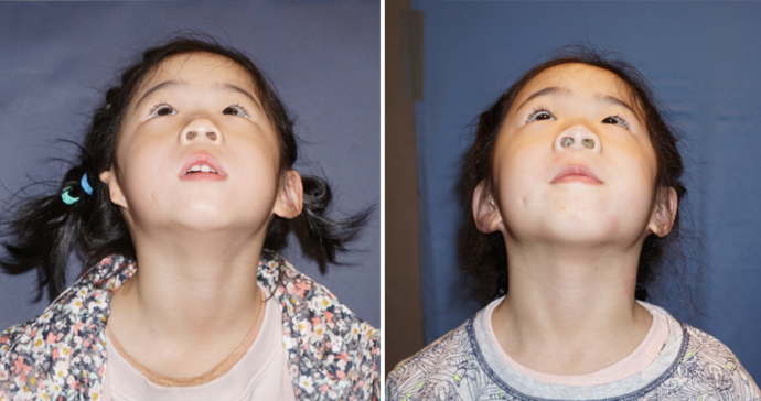 Single Ear: Case 4 - A 4 year old girl from China before & 1 year after a single Medpor surgery.