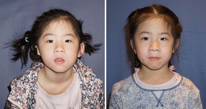Single Ear: Case 4 - A 4 year old girl from China before & 1 year after a single Medpor surgery.