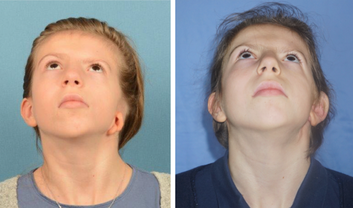 Single Ear: Case 6 - Seen before & after ear reconstruction.