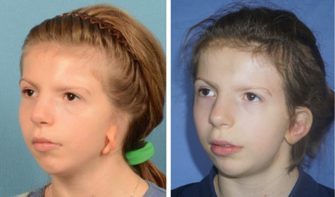 Single Ear: Case 6 - A 7 year old girl from France with a very low left mircrotia.