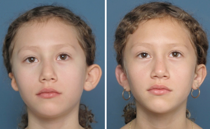 Single Ear: Case 2 - Seen 4 months after single outpaitient Medpor reconstruction.