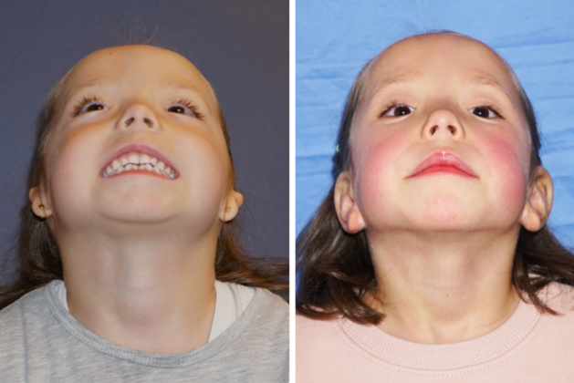 patient-2-combined-ear-canal-before-and-after-gallery