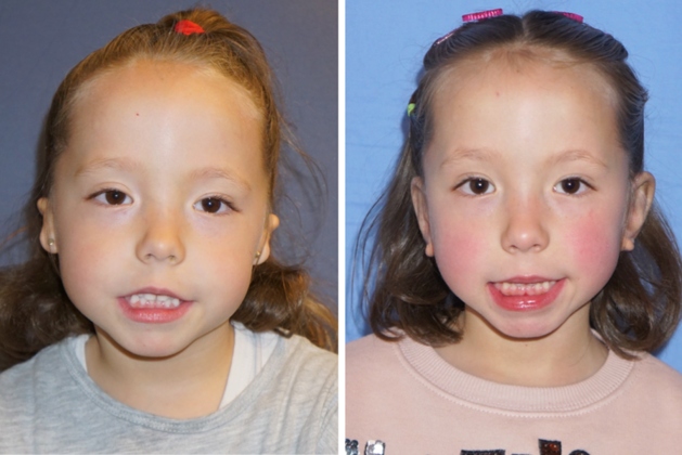 4 year old girl with bilateral microtia, before & 3 years after surgeries.