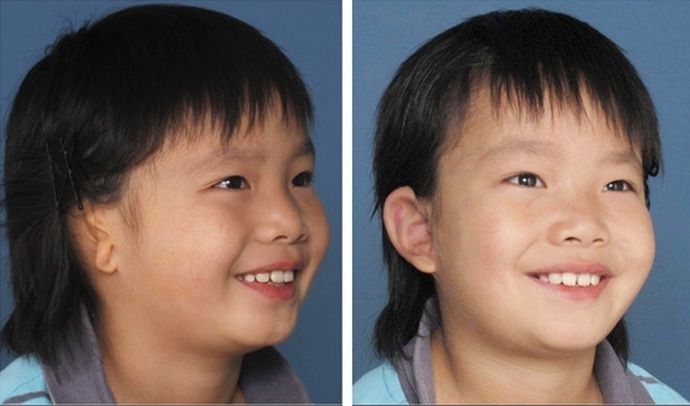 Combined Ear & Canal: Example 3 - Boy with right microtia before & 6 months after combined ear & canal surgery.