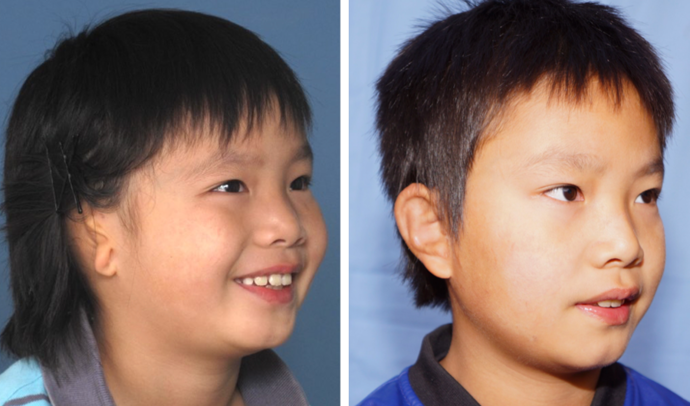 Combined Ear & Canal: Example 3 - Before & 5 years after combined ear & canal surgery.