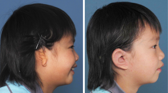 Combined Ear & Canal: Example 3 - Boy with right microtia before & 6 months after combined ear & canal surgery.