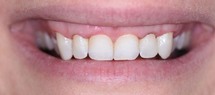 Gingivectomy Case 1 - Victoria, TX - After