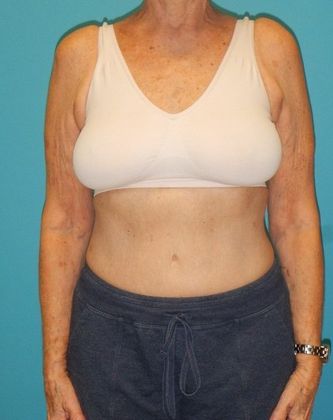 Arm Lift: Case 2 - Before