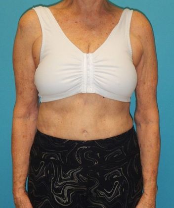 Arm Lift: Case 2 - After
