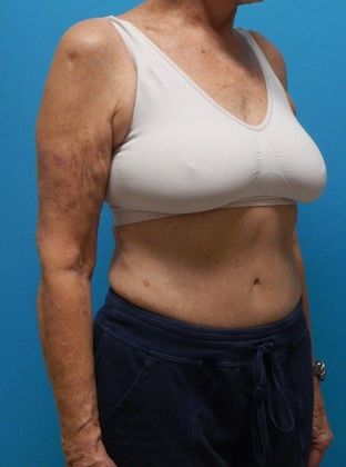 Arm Lift: Case 2 - Before