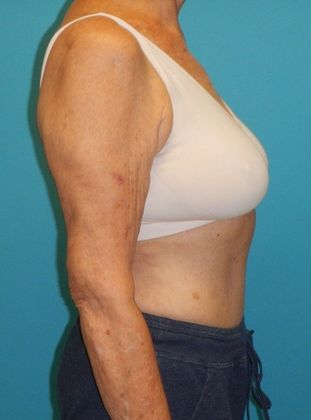 Arm Lift: Case 2 - Before