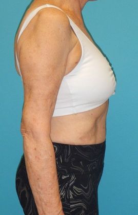 Arm Lift: Case 2 - After