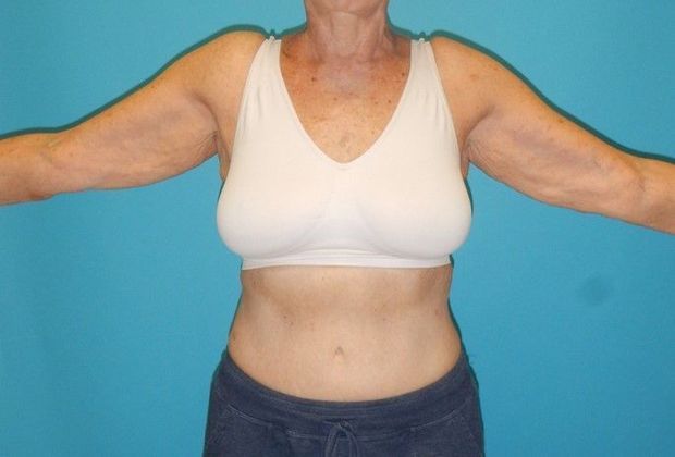 Arm Lift: Case 2 - Before