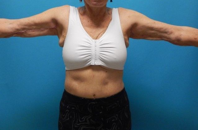 Arm Lift: Case 2 - After