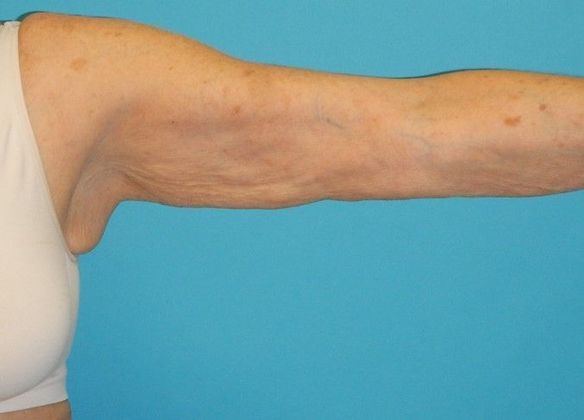 Arm Lift: Case 2 - Before