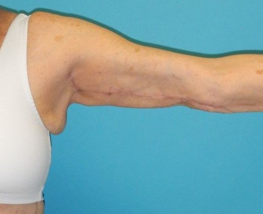 Arm Lift: Case 2 - After