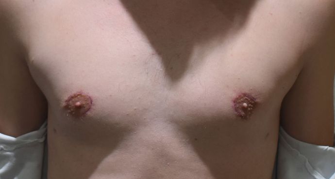 Gynecomastia Cases