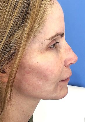 Rhinoplasty: Case 19 Rhinoplasty Windsor, CT - After