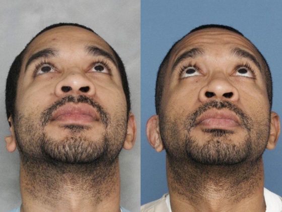 31 year old following car accident & 10 years after single surgery.