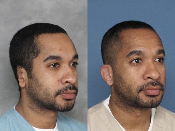 31 year old following car accident & 10 years after single surgery.
