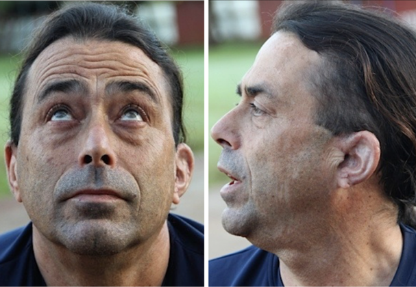 Ear surgery results 4 months after a single outpatient surgery.