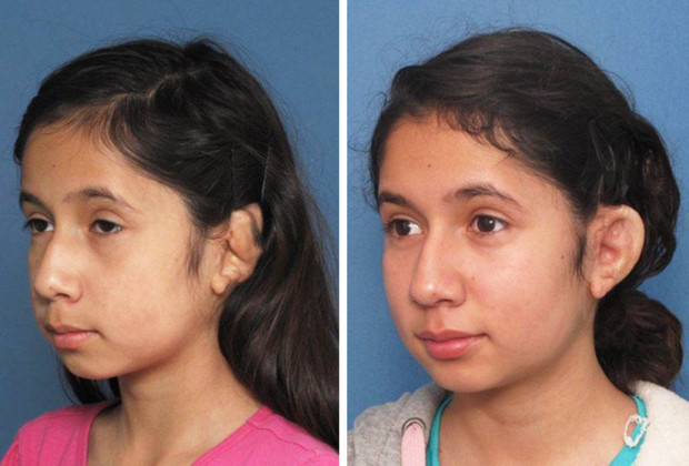 Correcting Prior Surgeries: Example 2 - Left ear after a prior unsatisfactory surgery & 1 year after surgery.