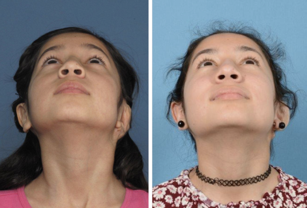 Correcting Prior Surgeries: Example 2 - Left ear after a prior unsatisfactory surgery & 5 years after surgery.