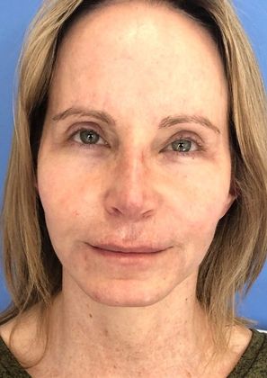 Eyelid Lift: Case 18 Eyelid Lift, Windsor, CT - After