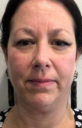 Facelift: Case 20 Facelift, Necklift Westport - Before