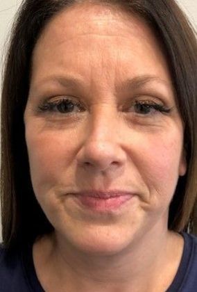 Facelift: Case 20 Facelift, Necklift Westport - After