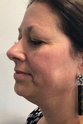 Facelift: Case 20 Facelift, Necklift Westport - Before
