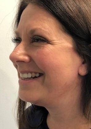 Facelift: Case 20 Facelift, Necklift Westport - After