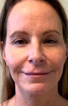 Facelift: Case 24 Facelift, Eyelids, Rhinoplasty Windsor, CT - Before