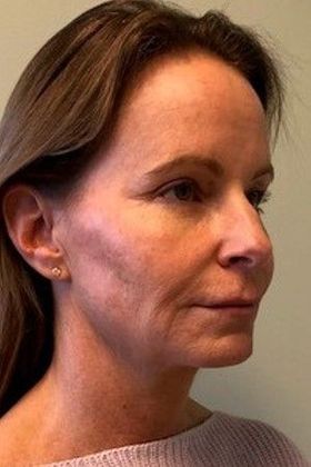 Facelift: Case 24 Facelift, Eyelids, Rhinoplasty Windsor, CT - Before