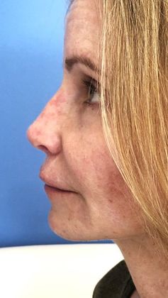 Facelift: Case 24 Facelift, Eyelids, Rhinoplasty Windsor, CT - After