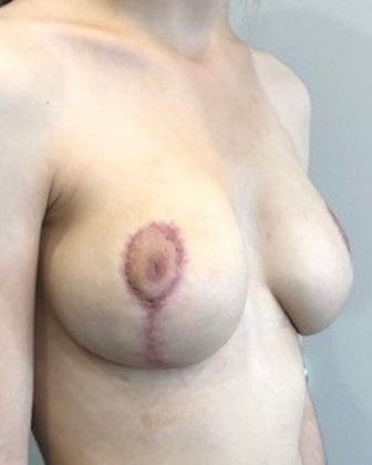 Breast Reduction: Case 11 Breast Reduction New Canaan, CT - After