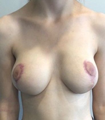 Breast Reduction: Case 11 Breast Reduction New Canaan, CT - After