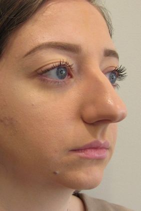 Rhinoplasty Case 8 - Rhinoplasty Fairfield - Before