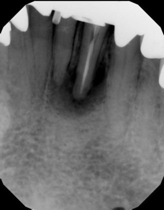 Dental Implants Case 30 - Before