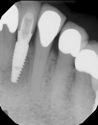 Dental Implants Case 30 - After