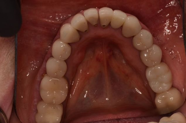 Dental Implants: Case 30 - After