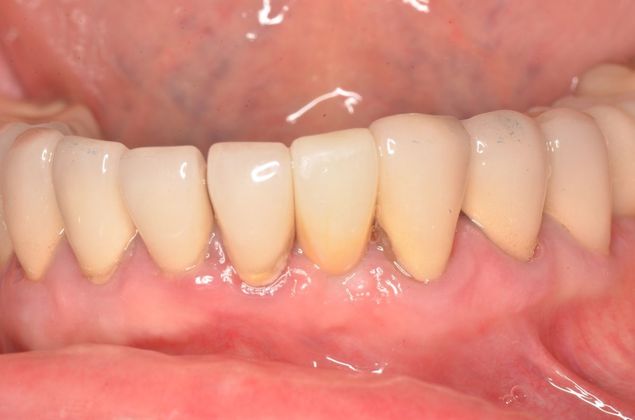 Dental Implants: Case 30 - Before