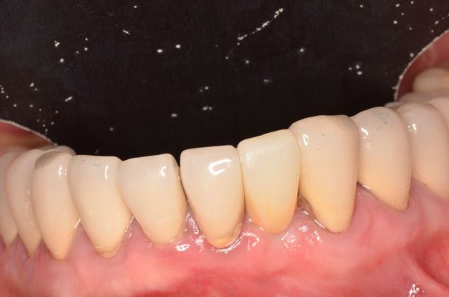 Dental Implants: Case 30 - After