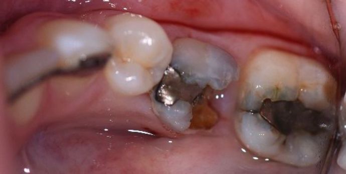 Dental Implants Case 1 - Victoria, TX - Before